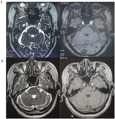 Comparison of microvascular decompression and percutaneous balloon compression efficacy in patients with V2 idiopathic trigeminal neuralgia